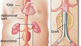 Abdominal Aort Anevrizmaları