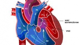 Adams Stokes Sendromu Senkop