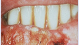 Ağız Kanseri Nedir