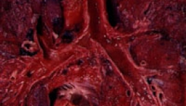 AkciÄŸer Apseleri Neden Olur?