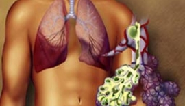 Akciğer Apsesi Ameliyatı