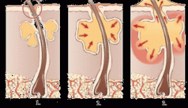 Akne Ergenlik Sivilceleri Tedavisi
