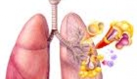 Allerjik Astım Tanısı