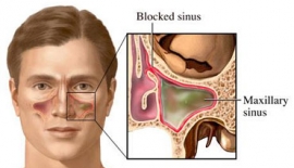 Allerjik Burun Sinüs Hastalıkları