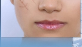 Ameliyat Yarası Vücudu Çirkinleştirir Mi?