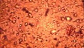 Amipli Dizanteri TeÅŸhisi