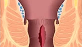 Anal Fissürler Anüste Çatlak