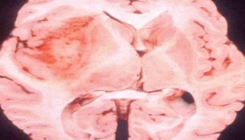 Anaplastik Astrositom