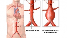 Anevrizma