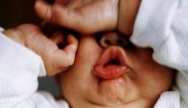 Anne Sütü İle Bulaşan Sarılık