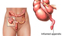 Apandisit Hastalığı Nedir?
