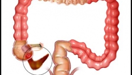 Apandisitin Kesin Tedavisi