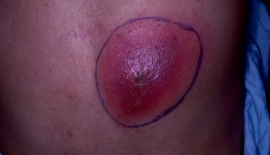 Apseler Ve İltihaplar