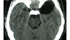 Araknoid Kist