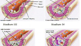 Arterioskleroz Damar SertliÄŸi