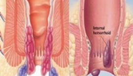 Arteriyovenöz Malformasyon