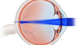 Astigmat Nedir?