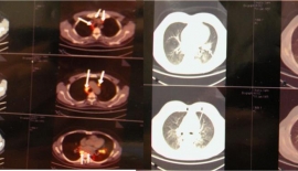 Atelektazinin Sebebi Nedir?