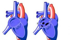 Atrial Septal Defekt Asd Çocukta