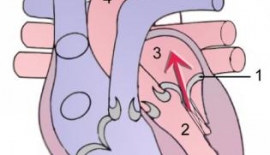 Atriyoventriküler Septal Defekt