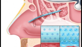 Balon İle Sinüzit Tedavisi