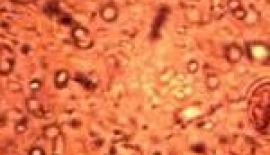 Basilli Dizanteri İshal Tedavisi