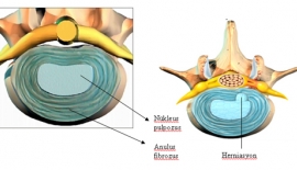 Bel Fıtığı Tedavisi