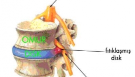 Bel Fıtığı Teşhisi
