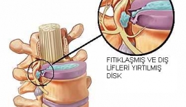 Bel Fıtığı