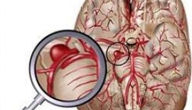 Beyin Kanaması Beyin Kanamaları