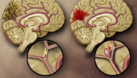 Beyin Kanaması Nedir