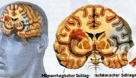 Beyin Kanamasi