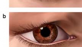 Blepharoplasty
