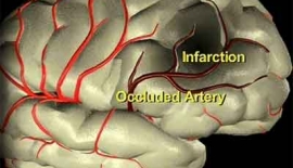 Braın Infarctıon