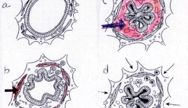 Bronşial Astım Nöbeti Astma