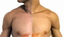 Bulaşıcı Veya Salgın Sarılık