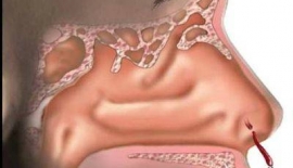 Burun Kanamasının Nedenleri