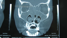 Burun Polipleri Nedir?