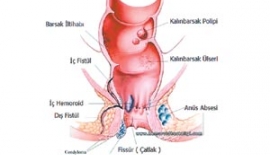 Crohn Hastalığı