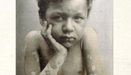 Cüzzam Lepra Tedavisi