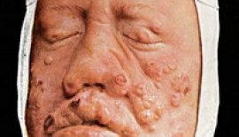 Cüzzamın İyileşme İmkânı Var Mıdır?