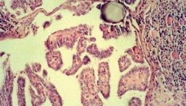 Papiller Tiroid Kanseri