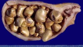 Safra Taşı Tedavisi