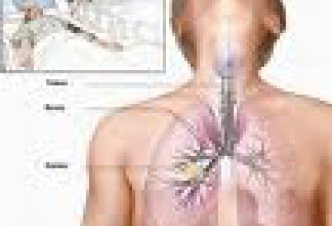 Akciğer Kistleri Nasıl Tedavi Edilir?