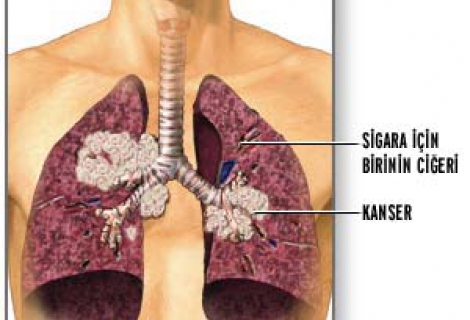 Akciğer Kistlerine Nerede Rastlanır?