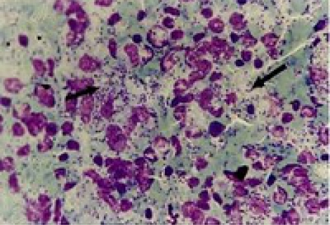 Amipli Dizanterinin Nedenleri