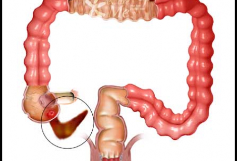 Apandisitin Kesin Tedavisi