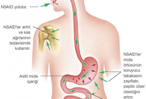 Artritin Tedavisinde Kortizonun Rolü Nedir?