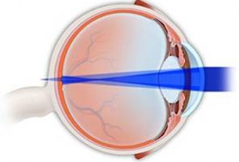 Astigmat Nedir?