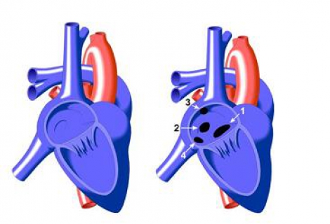 Atrial Septal Defekt Asd Çocukta